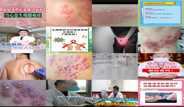 汕头生殖医院 - 汕头男人生殖疱疹怎么治疗