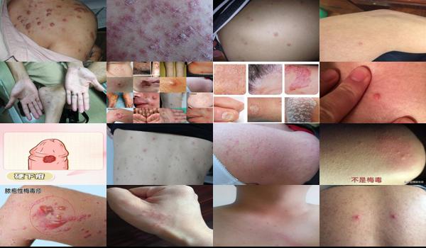 男性下面梅毒早期症状 - 汕头男性体下有痘痘都是梅毒图片