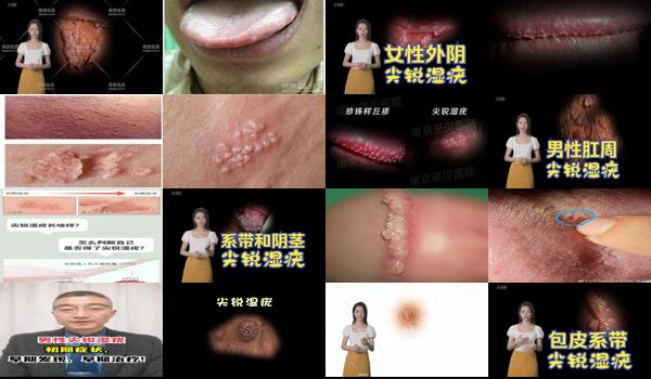 汕头*好的割包皮医院是哪家 - 汕头包皮尖锐湿疣早期症状图片