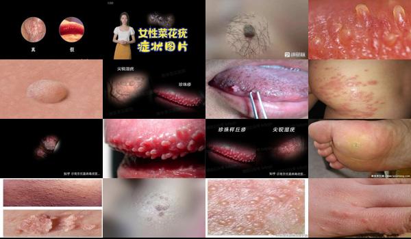 汕头治疗湿疹的医院 - 汕头尖锐湿疹初期症状图片