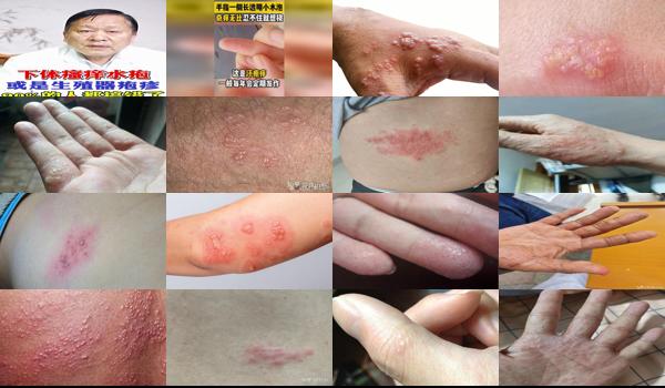 男性疱疹会痒吗? - 汕头男性疱疹会痒吗