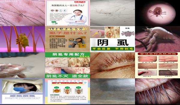 阴虱 头虱 - 汕头阴虱的产生和治疗