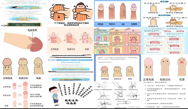 汕头*男科医院 - 汕头勃起障碍跟包皮有关吗