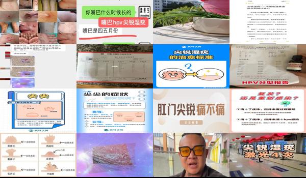 尖锐湿没有疣体怎么治疗 - 汕头尖锐湿疣没有尖尖