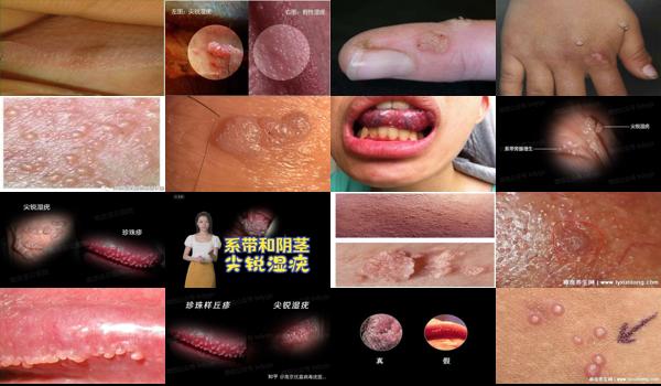 汕头治疗尖锐*好的医院 - 汕头男性尖锐湿尤图初期图片