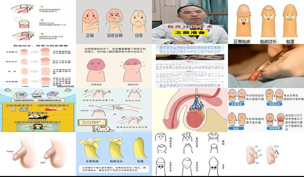 汕头包皮手术多少钱 - 汕头包皮过长的图