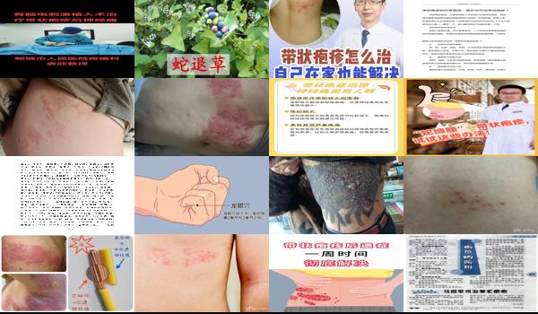 汕头带状疱疹苗接种 - 汕头治带状疱疹的土方法