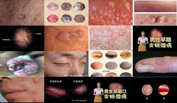 汕头男性*医院哪里比较好 - 汕头男性尖锐湿疣初期图片