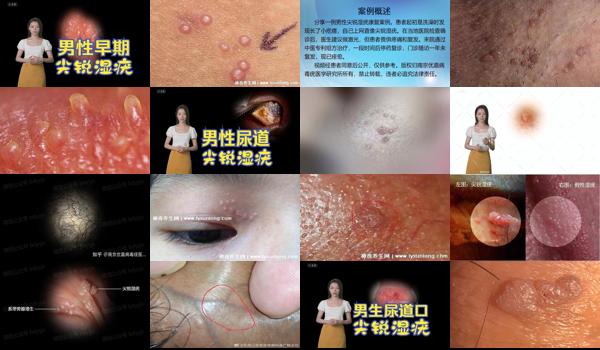 汕头治疗尖锐*好的医院 - 汕头男性尖锐初期图片百度