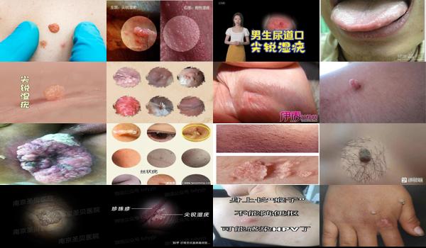 汕头男性*医院哪里比较好 - 汕头尖锐早期图片 男性