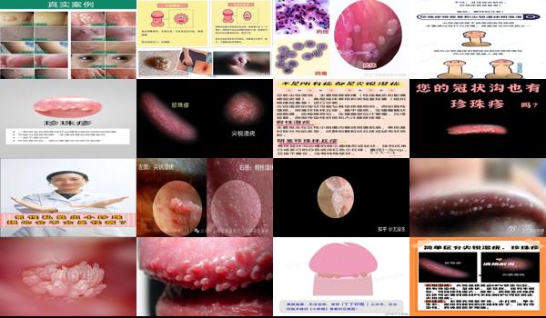 珍珠疹与尖锐湿疹区别有那些 - 汕头珍珠疹和尖锐湿疣的区别
