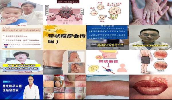 汕头大人得了疱疹会传染给小孩吗视频 - 汕头大人得了疱疹会传染给小孩吗