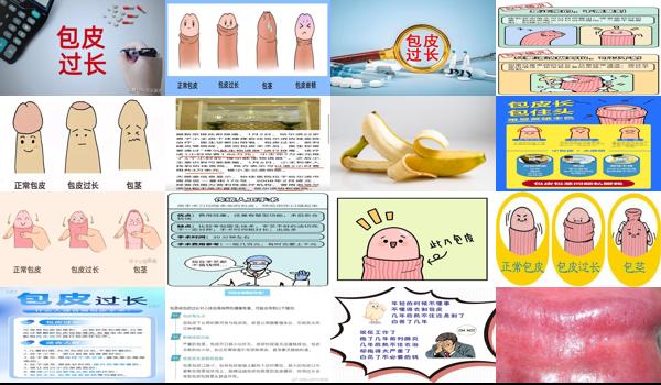 包皮过长感染怎么治疗 - 汕头包皮过长感染发炎症状