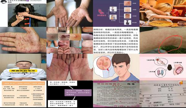 汕头梅毒哪里治疗 - 汕头为什么说梅毒会痛不欲生
