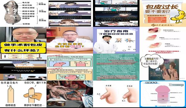汕头割包皮要多少钱 - 汕头割包皮有坏处吗