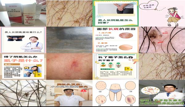 汕头男性 - 汕头男人长阴虱是什么原因引起的