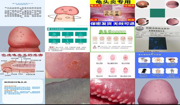 汕头男科性疾病 - 汕头各种龟头炎症状
