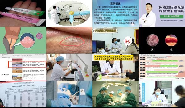 尖疣湿锐激光手术后伤口多久可以好 - 汕头尖锐湿疣激光后伤口怎么处理