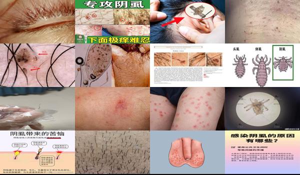 阴虱头虱体虱图片 - 汕头阴虱是什么病引起的