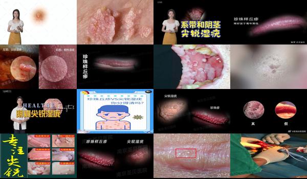 汕头治疗尖锐*好的医院 - 汕头包皮尖锐湿疣图片