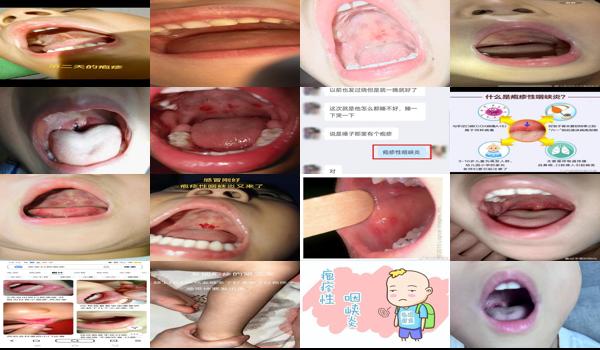 汕头疱疹性咽颊炎疫苗 - 汕头疱疹性咽颊炎