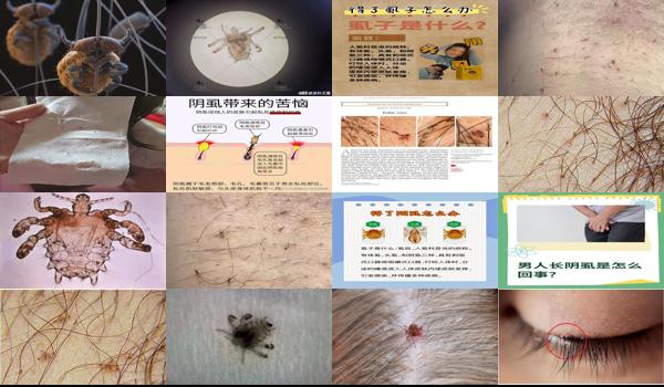 阴虱 头 - 汕头阴虱是怎么生出来的