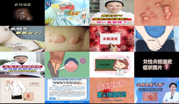 汕头市hiv感染者 - 汕头被感染尖锐几天*会出现症状
