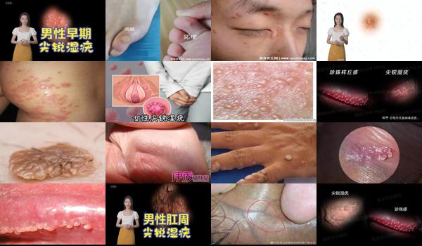 男性尖锐湿尤图治疗费用 - 汕头男性尖锐湿早期 尤图
