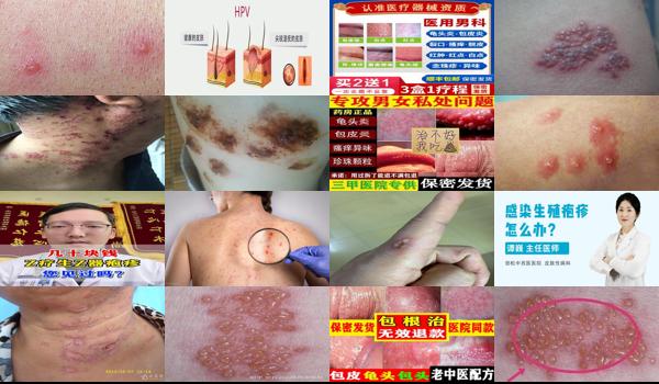 汕头*好的割包皮医院是哪家 - 汕头龟头上疱疹怎么治疗好得快