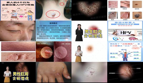 男性尖锐湿尤图治疗费用 - 汕头男人尖锐湿疣照片