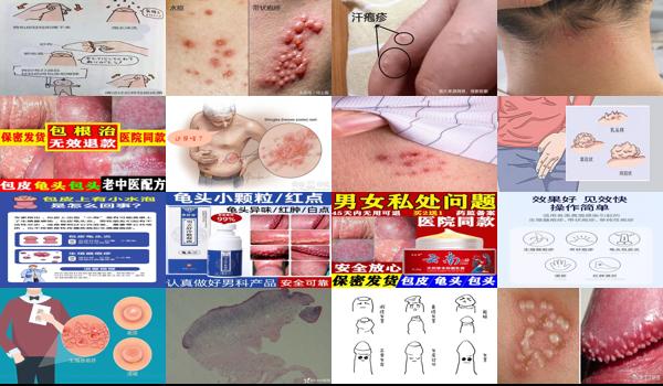 包皮 疱疹 - 汕头包皮疱疹是什么