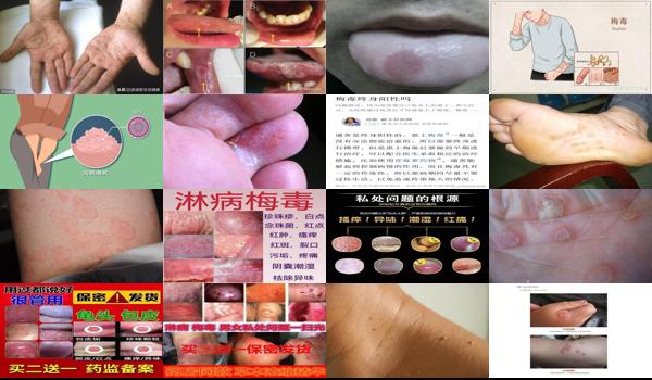 汕头梅毒哪里治疗 - 汕头梅毒龟头症状图片大*