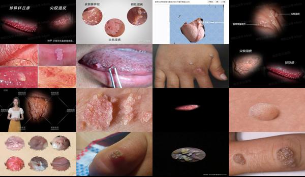 汕头 hpv - 汕头尖锐疣体*初图片