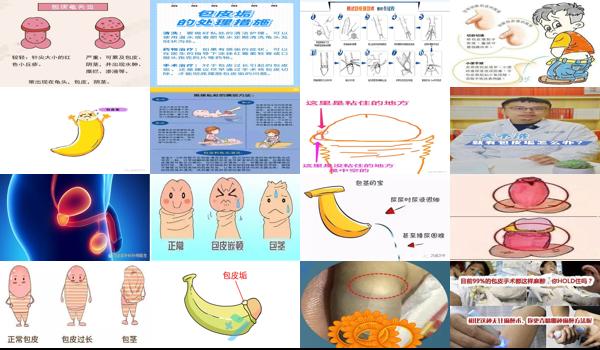 小孩有包皮垢怎么处理 - 汕头小孩有包皮垢怎么办