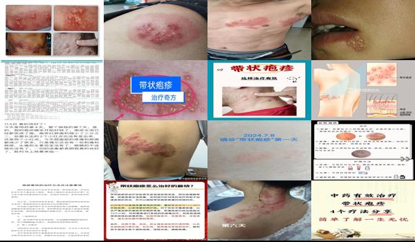 汕头有带状疱疹疫苗吗 - 汕头疱疹咋治疗好的快