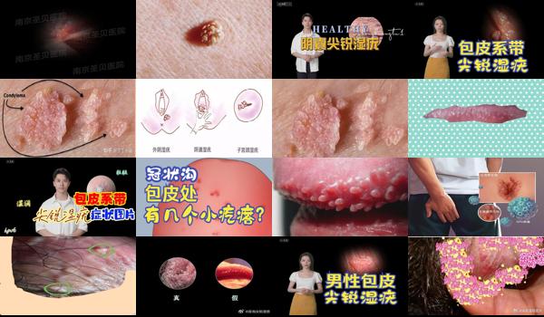 汕头包皮手术多少钱 - 汕头包皮尖锐湿疣症状