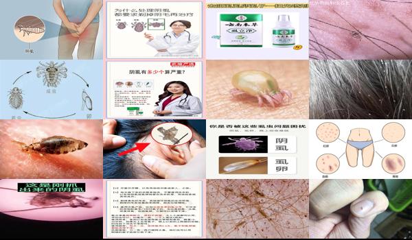 在头上抓到一个阴虱 - 汕头抓阴虱能抓干净吗