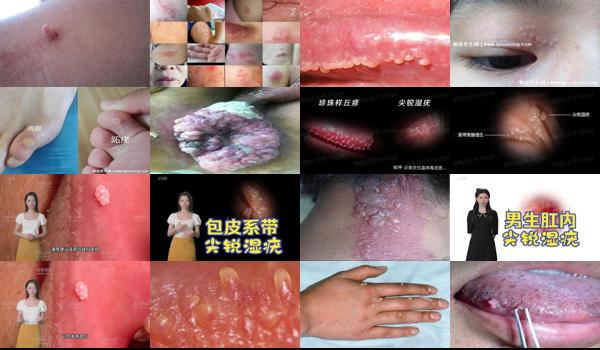 汕头 hpv - 汕头尖锐湿疣症状图片男