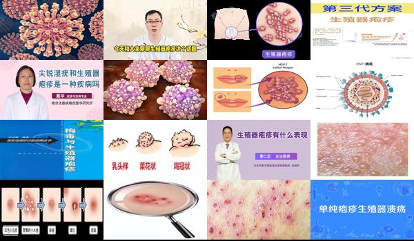 汕头生殖医院 - 汕头男性生殖器疱疹严重吗