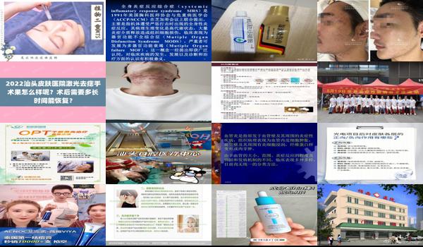 汕头哪里治疗脱发 - 汕头怎样褪炎症