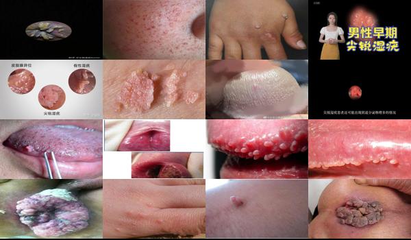 汕头 hpv - 汕头尖锐湿疣初期图片