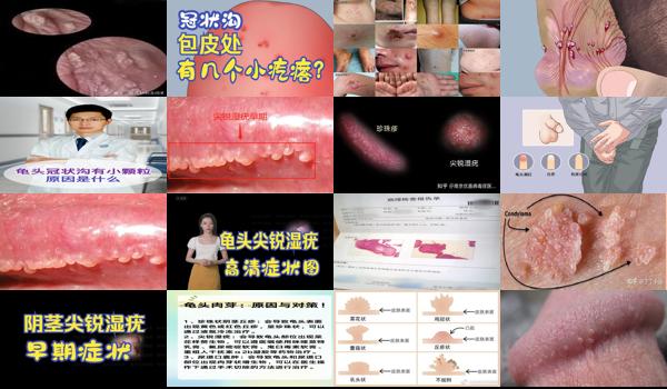 广东汕头男科医院 - 汕头男性龟头尖锐湿疣