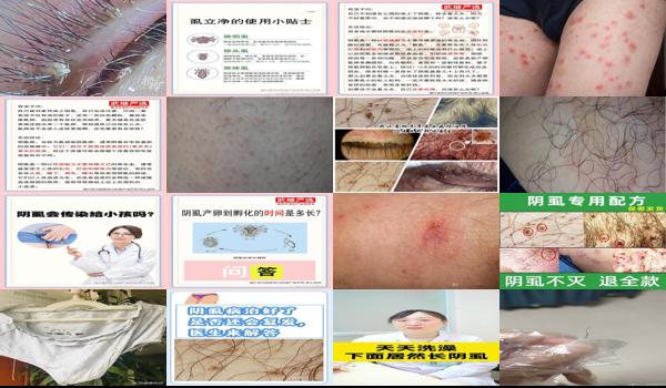 得了阴虱头上会有吗 - 汕头长过阴虱的会治好会发吗