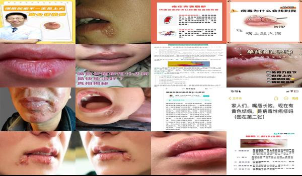 嘴巴头长疱疹 - 汕头嘴疱疹怎么引起的