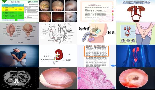 输尿管炎症怎么治 - 汕头输尿管炎症的临床表现