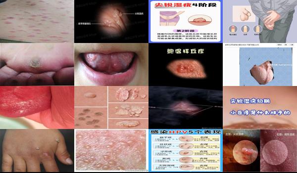 汕头看扁平疣的医院在哪里 - 汕头尖锐初期小丘疹图片