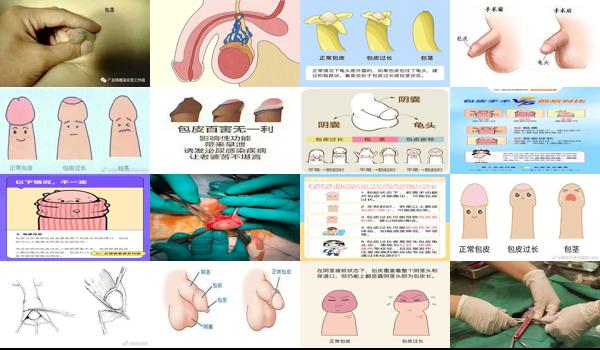 汕头包皮手术多少钱 - 汕头包头包皮过长图片