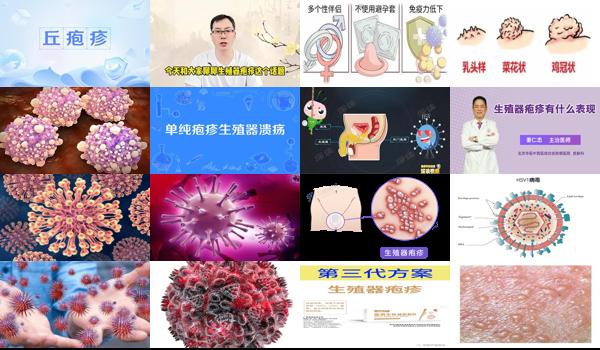 男士生殖疱疹 - 汕头男性生殖器疱疹是什么