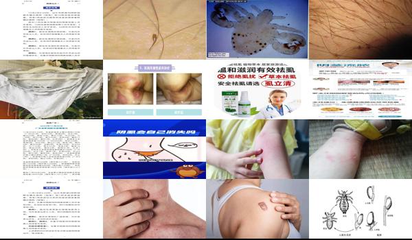 男人感染阴虱虫的症状 - 汕头男人感染阴虱虫四个表现