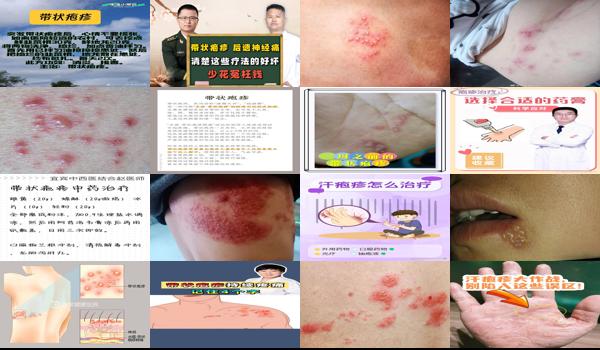 汕头有带状疱疹疫苗吗 - 汕头疱疹怎么治疗才好